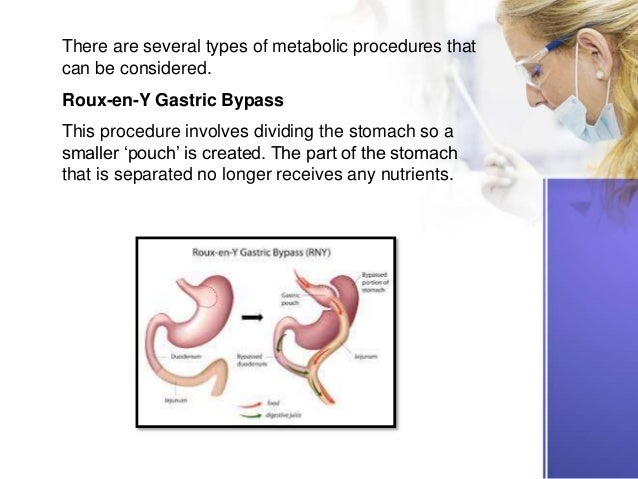 Surgical Treatment for Type 2 Diabetes