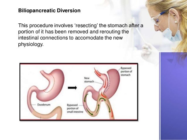 Surgical Treatment for Type 2 Diabetes