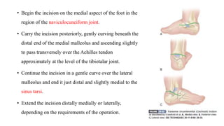 Foot Incision Surgical treatment of CTEV | PPTX