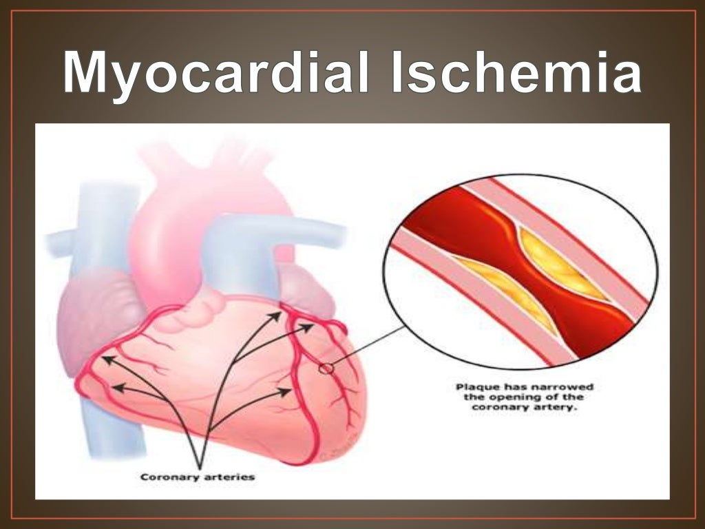 Surgical treatment of myocardial ischemia