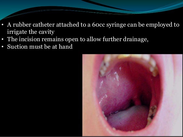 Surgical Treatment Of Paraphyrngeal And Retropharyngeal Abscesses surgical-treatment-of-paraphyrngeal-and-retropharyngeal-abscesses