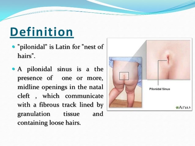 Medical Definition of Dermoid cyst of the ovary - MedicineNet