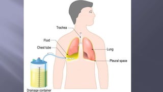 Surgical Tubes used in General Surgery