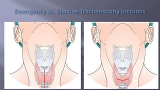 Surgical Tubes used in General Surgery