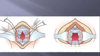 Surgical Tubes used in General Surgery