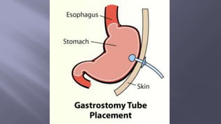 Surgical Tubes used in General Surgery