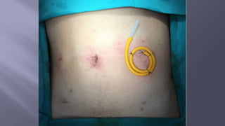 Surgical Tubes used in General Surgery