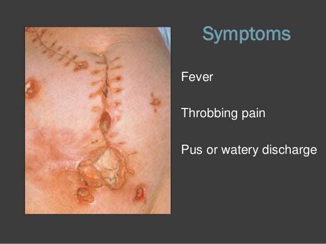 Surgical Wound Infection Symptoms, Diagnosis, Treatments ...