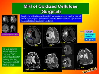 MRI of Oxidized CelluloseMRI of Oxidized Cellulose
(Surgicel)(Surgicel)
26 y.o. patient26 y.o. patient
with infiltrativewith infiltrative
primary CNSprimary CNS
tumor (waiting fortumor (waiting for
biopsy results).biopsy results).
Postsurgical MRIPostsurgical MRI
after 3 days.after 3 days.
Initial Diagnostic MRIInitial Diagnostic MRI
TSE T1 GE T2
TSTIR B50
B500
B1000 ADC
Surgicel is a bioabsorbable topical haemostatic agent used to control
bleeding in surgical procedures. How to differentiate its signal from
Haemoglobin degradation products?
SurgicelSurgicel
HemoglobinHemoglobin
ProductsProducts
FLAIR
TumorTumor
 