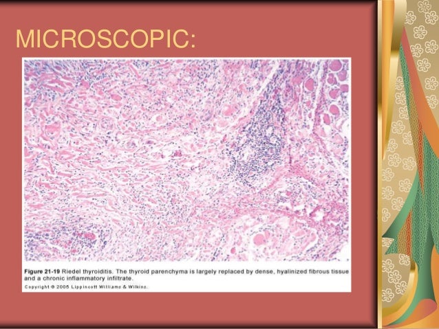 Riedel stroma thyroid