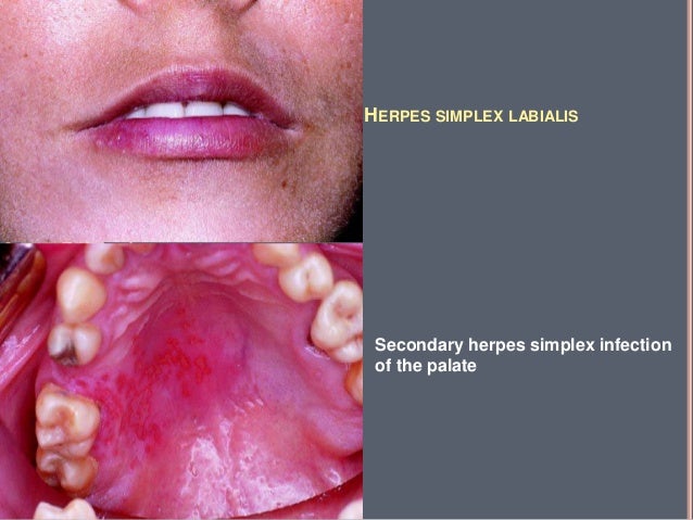 Sur mucosal lesions