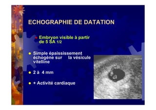 ECHOGRAPHIE DE DATATION
Embryon visible à partir
de 5 SA 1/2
Simple épaississement
échogène sur la vésicule
vitelline
2 à 4 mm
+ Activité cardiaque
 