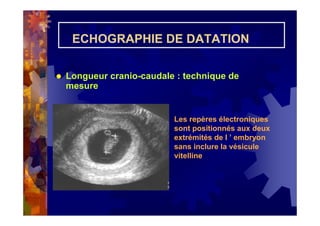 ECHOGRAPHIE DE DATATION
Longueur cranio-caudale : technique de
mesure
Les repères électroniques
sont positionnés aux deux
extrémités de l ’ embryon
sans inclure la vésicule
vitelline
+
+
 