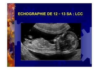 ECHOGRAPHIE DE 12 – 13 SA : LCC
 