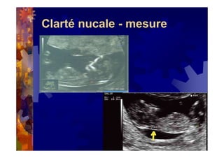 Clarté nucale - mesure
 