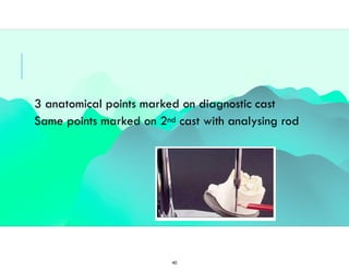 Surveying in removable partial denture.. | PDF