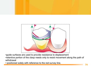 Surveying Rpd Surveyor and technique of Surveying in Removable partial denture | PPTX