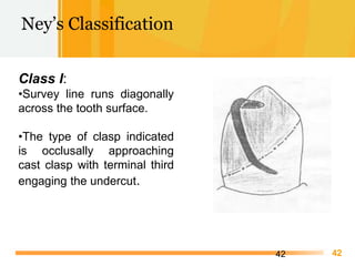 Free Powerpoint Templates
42
Class I:
•Survey line runs diagonally
across the tooth surface.
•The type of clasp indicated
...