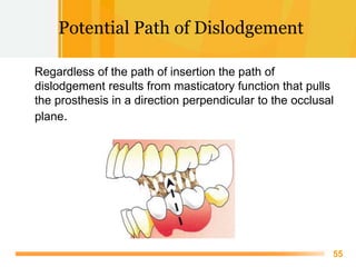 Free Powerpoint Templates
55
Potential Path of Dislodgement
Regardless of the path of insertion the path of
dislodgement r...