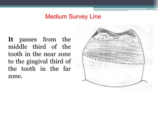 It passes from the
middle third of the
tooth in the near zone
to the gingival third of
the tooth in the far
zone.
Medium Survey Line
 