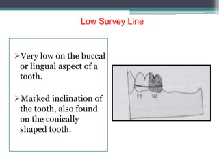 Low Survey Line
Very low on the buccal
or lingual aspect of a
tooth.
Marked inclination of
the tooth, also found
on the conically
shaped tooth.
 
