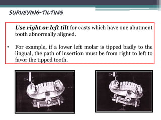 Use right or left tilt for casts which have one abutment
tooth abnormally aligned.
• For example, if a lower left molar is tipped badly to the
lingual, the path of insertion must be from right to left to
favor the tipped tooth.
SURVEYING-TILTING
 
