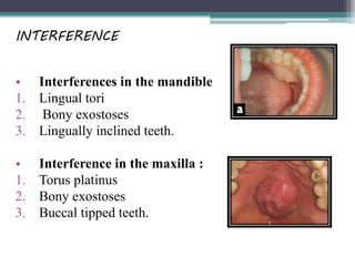 INTERFERENCE
• Interferences in the mandible
1. Lingual tori
2. Bony exostoses
3. Lingually inclined teeth.
• Interference in the maxilla :
1. Torus platinus
2. Bony exostoses
3. Buccal tipped teeth.
 