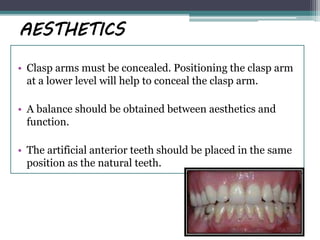AESTHETICS
• Clasp arms must be concealed. Positioning the clasp arm
at a lower level will help to conceal the clasp arm.
• A balance should be obtained between aesthetics and
function.
• The artificial anterior teeth should be placed in the same
position as the natural teeth.
 