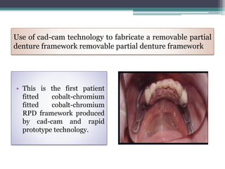 Use of cad-cam technology to fabricate a removable partial
denture framework removable partial denture framework
• This is the first patient
fitted cobalt-chromium
fitted cobalt-chromium
RPD framework produced
by cad-cam and rapid
prototype technology.
 