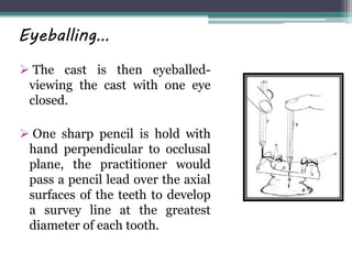  The cast is then eyeballed-
viewing the cast with one eye
closed.
 One sharp pencil is hold with
hand perpendicular to occlusal
plane, the practitioner would
pass a pencil lead over the axial
surfaces of the teeth to develop
a survey line at the greatest
diameter of each tooth.
Eyeballing…
 