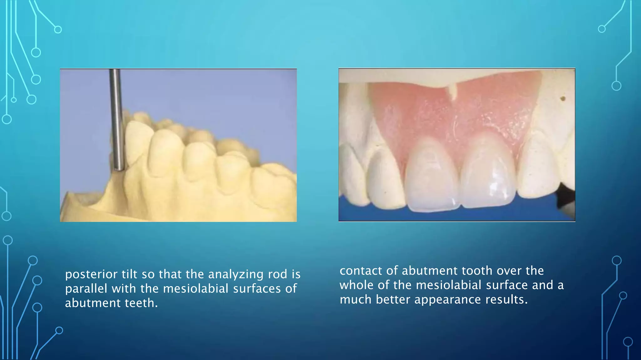 Surveying in Removable Prosthodontics | PPTX | Dental Health | Diseases ...