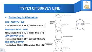 TYPES OF SURVEY LINE
▸ According to Blatterfein
HIGH SURVEY LINE
from Occlusal 1/3rd In NZ to Occlusal 1/3rd In FZ
MEDIUM SURVEY LINE
from Occlusal 1/3rd In NZ to Middle 1/3rd In FZ
LOW SURVEY LINE
From cervical 1/3rd In NZ To cervical 1/3rd In FZ
DIAGONAL SURVEY
Fromocclusal 1/3rd in NZ to gingival 1/3rd inFZ
37
 