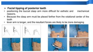 44
 Facial tipping of posterior teeth
• positioning the buccal clasp arm more difficult for esthetic and mechanical
reasons.
• Because the clasp arm must be placed farther from the rotational center of the
tooth
• lever arm is longer, and the resultant forces are likely to be more damaging
 