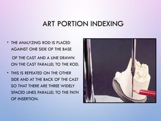 Surveying in removable partial dentures (RPD) involves evaluating ...