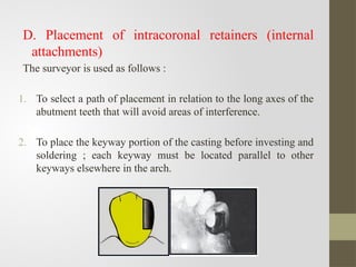 Internal Attachment Rpd Comprehensive Guide to Surveying in Removable Partial Denture Design | PPTX