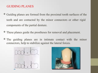 Comprehensive Guide to Surveying in Removable Partial Denture Design | PPTX