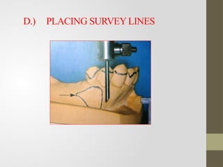Surveying Rpd Comprehensive Guide to Surveying in Removable Partial Denture Design | PPTX