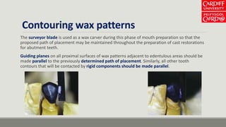 Contouring wax patterns
The surveyor blade is used as a wax carver during this phase of mouth preparation so that the
proposed path of placement may be maintained throughout the preparation of cast restorations
for abutment teeth.
Guiding planes on all proximal surfaces of wax patterns adjacent to edentulous areas should be
made parallel to the previously determined path of placement. Similarly, all other tooth
contours that will be contacted by rigid components should be made parallel.
 