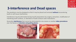 3-Interference and Dead spaces
The prosthesis must be designed so that it may be placed and removed without encountering
tooth or soft tissue interference.
Interference may be eliminated during mouth preparations by surgery, extraction, modification of
interfering tooth surfaces, or alteration of tooth contours with restorations.
Generally, interference that cannot be eliminated for one reason or another takes precedence
over the factors of retention and guiding planes.
 