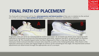FINAL PATH OF PLACEMENT
The final path of placement will be the anteroposterior and lateral position of the cast, in relation to the vertical
arm of the surveyor that best satisfies all factors: guiding planes, retention, interference, esthetics.
Diagnostic casts can serve as a visual guide for tooth preparation. A, Surveyed cast shows areas requiring tooth
reduction in red (mesio-occlusal rest and distal guide plane #28, cingulum rest #27), as well as path of insertion
tripod marks. B, This mesially tipped molar has been diagnosed to have a ring clasp. Red markings show the
necessary mesio-occlusal and disto-occlusal rests required, as well as the mesial guide plane. Also shown is the
reduction necessary to lower the lingual height of contour at the mesiolingual line angle. All required axial contour
adjustments are determined through the appropriate use of a surveyor.
A B
 