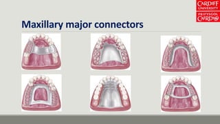 Maxillary major connectors
 