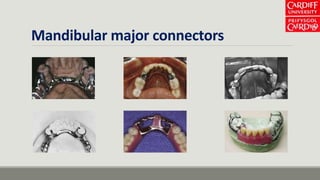 Mandibular major connectors
 