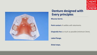 Denture designed with
Every principles
Mucosa borne.
Point contact of saddles with abutments.
Gingivally free as much as possible (minimum 3mm).
Labial flange.
Distal stops.
 