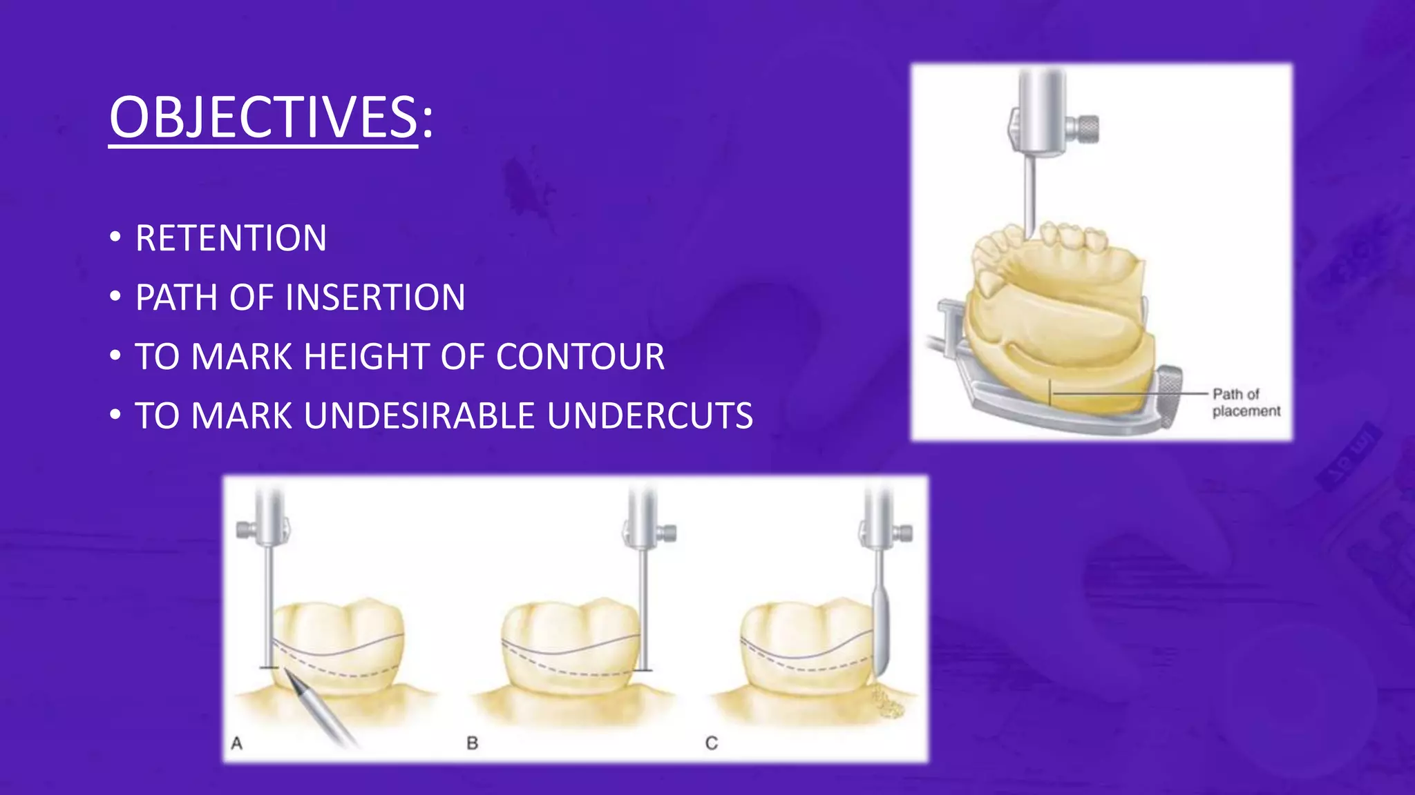 Surveyor For Rpd Surveying Tools. Prosthodontics 3rd year bds. Surveying. RPD ...