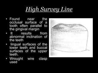 High Survey Line
• Found near the
occlusal surface of a
tooth often parallel to
the gingival margin
• It results from
abnormal inclination of
the teeth
• lingual surfaces of the
lower teeth and buccal
surfaces of the upper
teeth.
• Wrought wire clasp
used
 