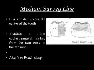 Medium Survey Line
• It is situated across the
center of the tooth
• Exhibits a slight
occlusogingival incline
from the near zone to
the far zone.
•
• Aker’s or Roach clasp
 