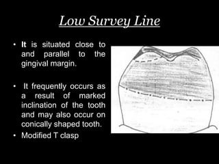 Low Survey Line
• It is situated close to
and parallel to the
gingival margin.
• It frequently occurs as
a result of marked
inclination of the tooth
and may also occur on
conically shaped tooth.
• Modified T clasp
 