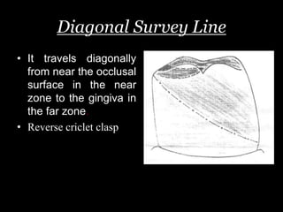 Diagonal Survey Line
• It travels diagonally
from near the occlusal
surface in the near
zone to the gingiva in
the far zone.
• Reverse criclet clasp
 