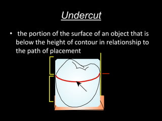Undercut
• the portion of the surface of an object that is
below the height of contour in relationship to
the path of placement
 