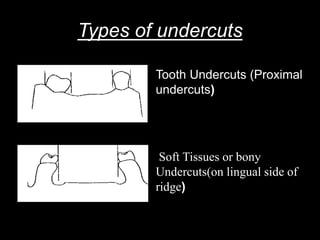 Types of undercuts
Tooth Undercuts (Proximal
undercuts)
Soft Tissues or bony
Undercuts(on lingual side of
ridge)
 